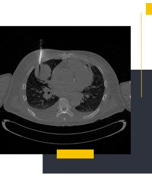 تفاوت نمونه‌برداری تحت گاید سونوگرافی، سی تی اسکن و MRI